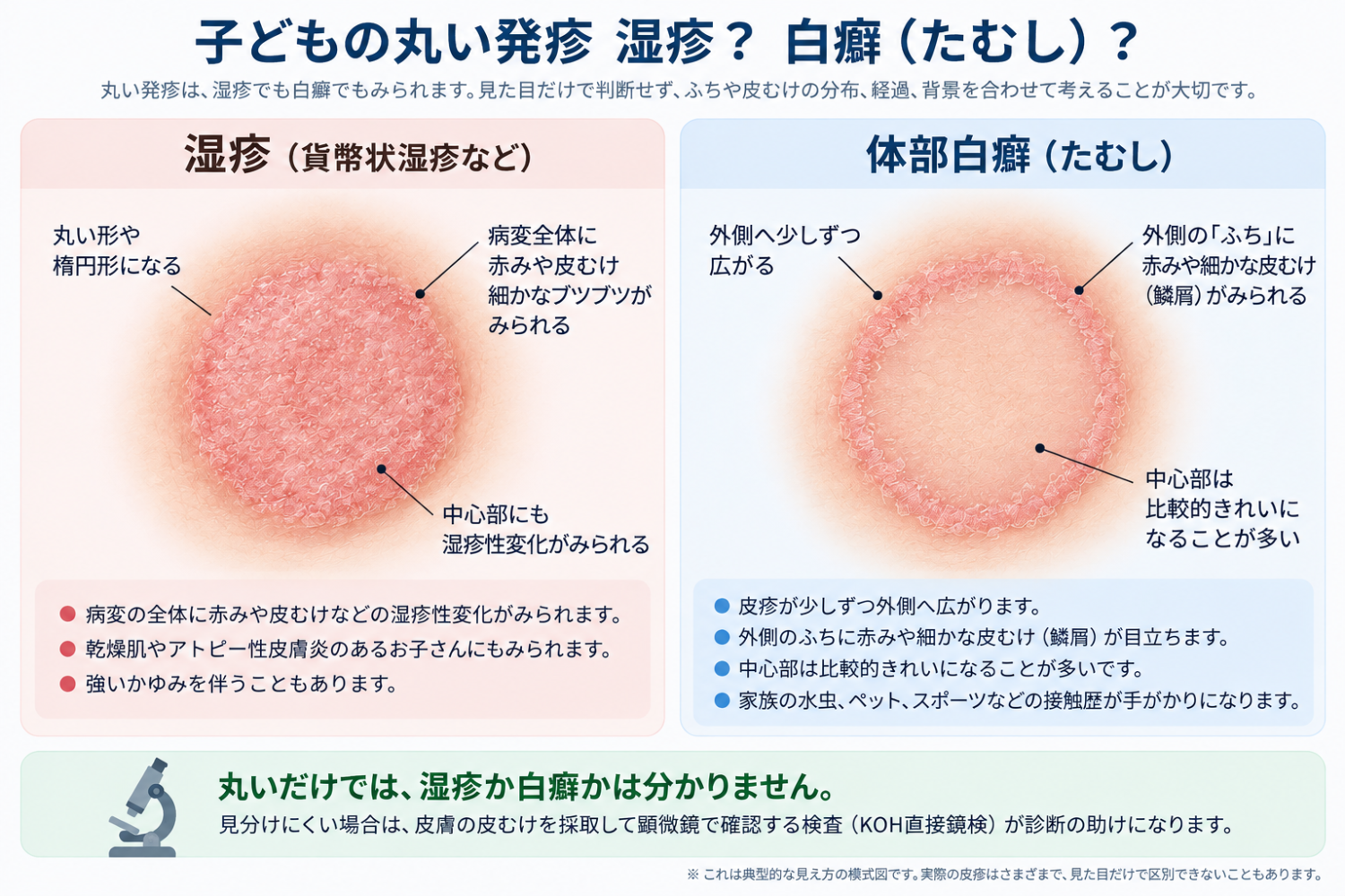 子どもの丸い発疹：湿疹と体部白癬（たむし）の見分け方の模式図