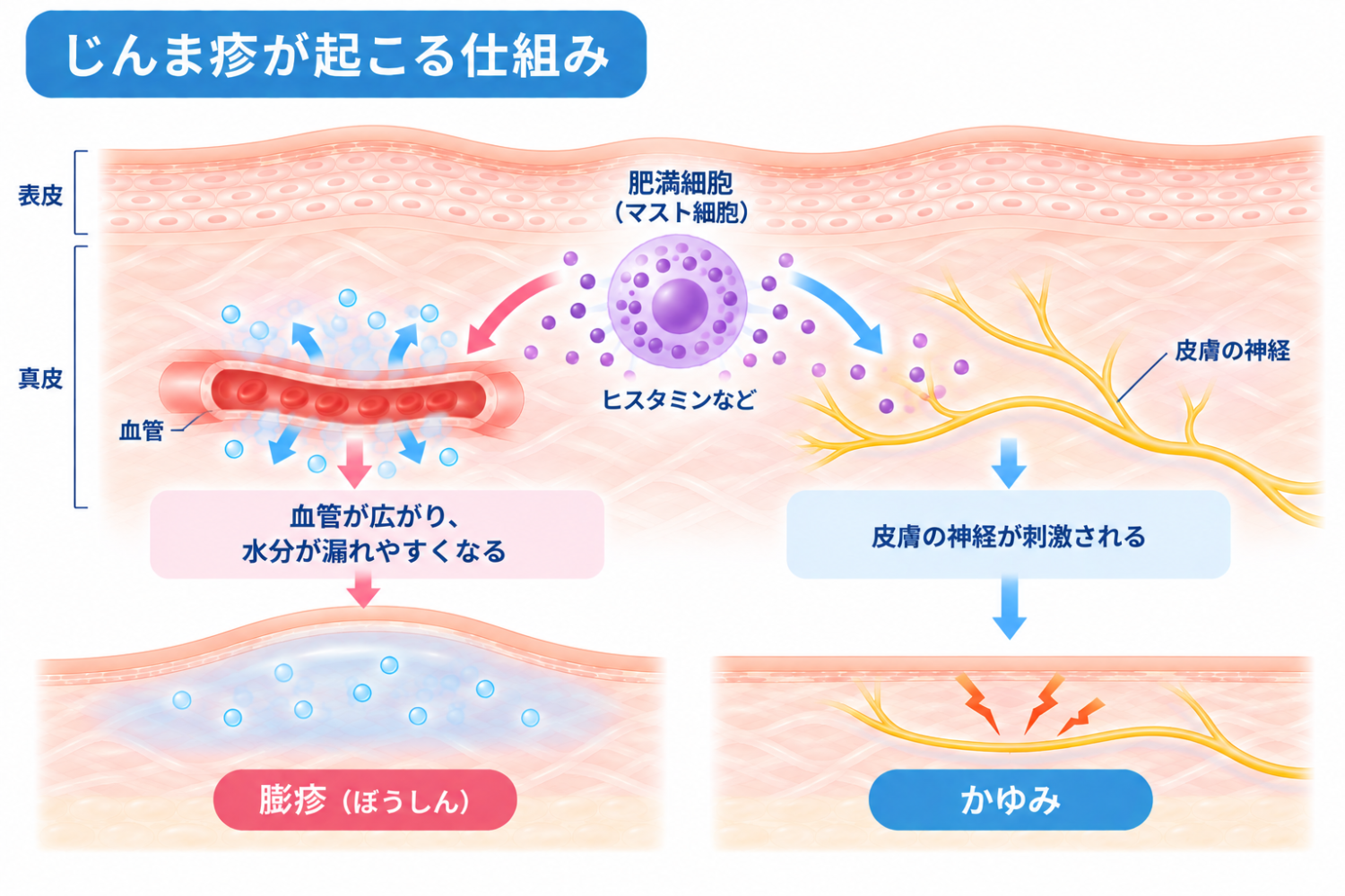 じんま疹が起こる仕組みの模式図。肥満細胞から放出されたヒスタミンなどが血管に作用して血管が広がり水分が漏れやすくなることで膨疹が生じ、皮膚の神経が刺激されることでかゆみが生じる流れを示す図